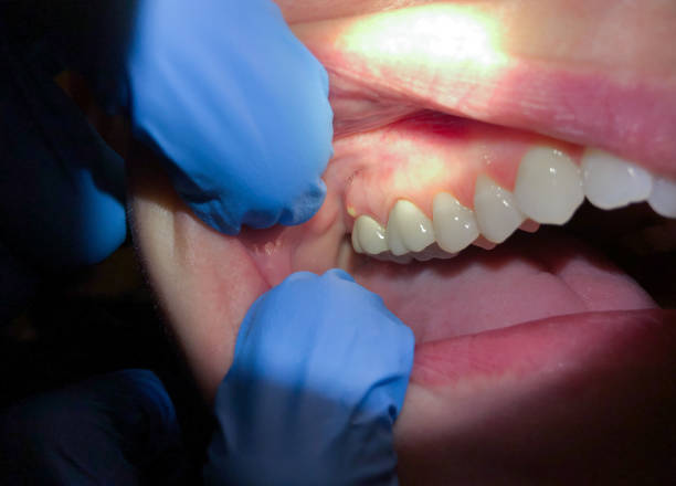 Best Emergency Treatment for Oral Infections in Juniper Canyon, OR